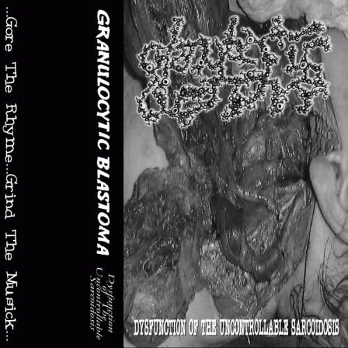 Granulocytic Blastoma : Dysfunction of the Uncontrollable Sarcoidosis